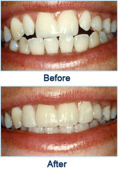 Houston Cosmetic Dentist - Teeth Crowns Tooth Crown, Smile Teeth, Dental Crowns, Health Heal, Perfect Smile, First Tooth, Dental Practice, Cosmetic Dentistry, Braces