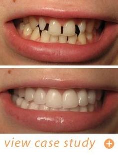 Broken Teeth, Natural Smile, Veneers Teeth, Easy Care Hairstyles, Aesthetic Dentistry, Dental Tourism, Teeth Bleaching, Porcelain Veneers, Perfect Teeth