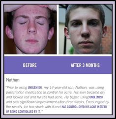 TEENAGER WITH ACNE??  Try Rodan+Fields' Unblemish regimen! * #1 acne treatment in the US! 💃🏽🕺 makes happy and confident teenagers 😉 * 60-day money-back guarantee!  Contact me for more info! pshenkman.myrandf.com Back Pimples, Happy And Confident, Back Acne Treatment, Neck And Back Pain, Make Happy, Medical Prescription, Young Living Essential Oils