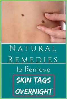 https://marmads.com/How-to-Remove-Skin-Tag-in Overnight Remedies, Beauty Tips With Honey, Dark Circles Around Eyes, Beauty Routine Tips, Remove Dark Circles, Perfect Skin Care Routine