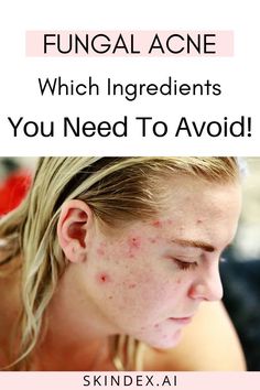 Ingredients To Avoid, Greasy Skin, Types Of Acne, Acne Problem, Cosmetics Ingredients, Cystic Acne, Skin Imperfection