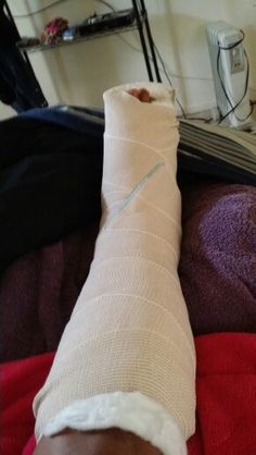 an injured person's leg with a cast on it