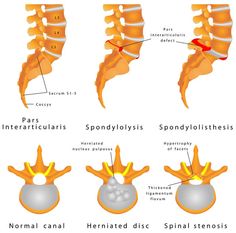 Spondylolisthesis Hip Problems, Spinal Nerve, Pelvic Floor Exercises, Sciatica Pain, Sciatic Nerve