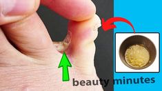 In this video we will show A wonderful home remedy for fungus between the toes foreverToday we offer you an effective home remedy for fungus between the toes... Learn Yoga Poses, Sleep Remedies, Cleanse Recipes, Fungal Infection, Healthy Diet Plans, Easy Vegetarian