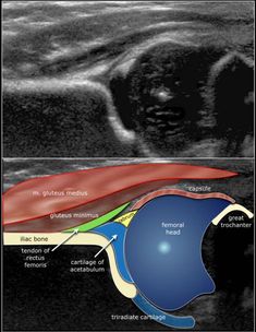 The Radiology Assistant : Developmental Dysplasia of the Hip - Ultrasound Ultrasound Anatomy, Developmental Dysplasia Of The Hip