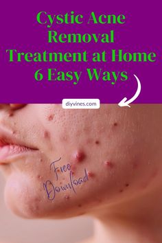 Cystic Acne Removal Treatment at Home: 6 Easy Ways Acne Removal, Clear Healthy Skin, Types Of Acne, Acne Care, Cystic Acne, Acne Free, Diy Skincare