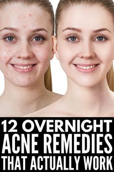 What Causes Warts, Sunspots On Face, Overnight Acne Remedies, Brown Age Spots, Brown Spots On Skin, Skin Care Routine For 20s, Get Rid Of Warts