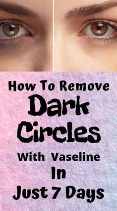 Dark Circle Remedies, Dark Circles Around Eyes, Dark Eye Circles, Remove Dark Circles, Dark Circles Under Eyes, Dark Circle, Eye Circles