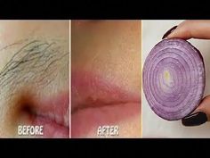 #Removing_ facial_hair_without_pain#removing_body_hair#removing_pubic_hait#eliminar_el_vello_facial_corporal._sin_dolor Diy Facial Hair Removal, Pubic Hair Removal, Bump Hairstyles, Stop Hair Breakage, Underarm Hair Removal, At Home Hair Removal, Remove Hair