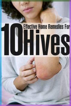 Hives are recurrent, harmless, and inflamed patches that appear on the skin. Home remedies for hives can help with treatment and relief of symptoms. Read on. Hives Relief, Remedies For Hives, Home Remedies For Hives, Hives Remedies, Feeding Newborn, Child Nutrition, Inner Health, Allergy Remedies, Everyday Health