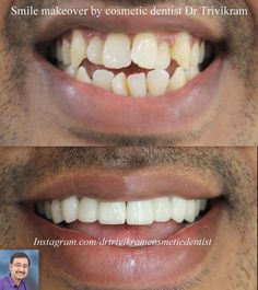 Teeth Drawing, Healthy Heart Tips, Facial Anatomy, Porcelain Veneers, Teeth Braces, Dental Center