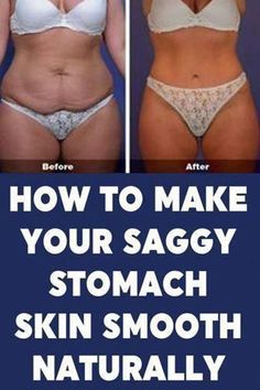 How To Tighten Loose Skin After Weight LossLumpUnderMySkin LumpUnderSkin HowToLoseSaggyStomachSkin CanYouTightenSaggyStomachSkin SaggyTummySkinTreatment FirmSaggyStomachSkin Sagging Belly, Flabby Stomach, Flabby Belly, Tighten Stomach, Sagging Cheeks, Skin Tightening Stomach, Loose Belly, Tighten Loose Skin, Saggy Skin