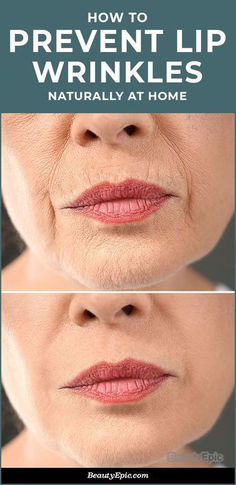 Derma Fillers, Wrinkles Remedies Face, Lip Wrinkles, Neck Wrinkles, Under Eye Wrinkles, Forehead Wrinkles, Glow Skin