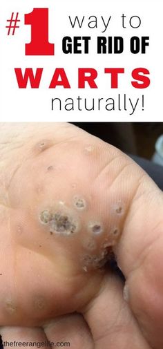 Warts can be painful and embarrassing to deal with. Ditch the over the counter chemicals and learn how to get rid of warts naturally! Natural Wart Remover, Planters Wart, Warts Remedy, Lose 40 Pounds, Natural Home Remedies, Natural Medicine, Health Remedies