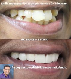 Crowding Teeth, Teeth With Braces, Attractive Smile, After Braces, Teeth Doctor, Teeth Whitening Toothpaste, Teeth Bleaching