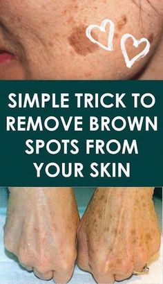 Sunspots On Face, Brown Spots On Hands, Brown Age Spots, Brown Spots On Skin, Dark Spots On Face, Brown Spots Removal, Brown Spots On Face, Skin Spots, Spots On Face