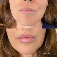 Lip Filler Technique, Botox And Filler, Lip Flip, Lip Lift, Saving Face, Danielle Smith