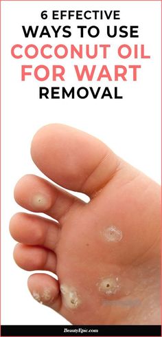 Warts Removal, Warts On Hands, Warts On Face, Natural Sleep Remedies, Natural Cold Remedies