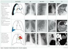 Pulmonary Disease, Radiology, Educational Materials, Anatomy, Disease, Twitter Sign Up