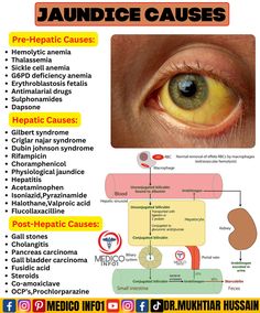 an eye with the words jaundicee cause and description in front of it