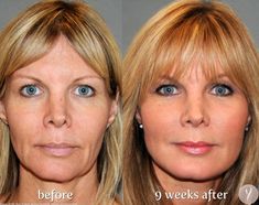 Liquid Facelift, Lifting Facial, Makeup Hacks Beauty Secrets