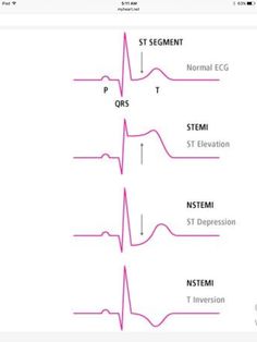 Myocardial Infarct, Cath Lab Nursing, Medical Student Study