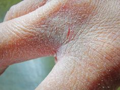 What Causes Dry Skin on Fingers?Several factors can contribute to dry skin on your fingers, including:Weather: Cold, dry air in the winter Dry Hands Remedy, Dry Hand Skin, Cracked Hands, Healing Ointment, Dry Skin Remedies, Extreme Close Up, Dry Air, Health Trends