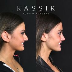 Rhinoplasty 31 — Kassir Plastic Surgery in NY and  NJ Ethnic Rhinoplasty, Nose Fillers, Chronic Sinusitis, Lips Inspiration, Facial Contouring, Celebrity Plastic Surgery, Breast Augmentation, Bleached Hair