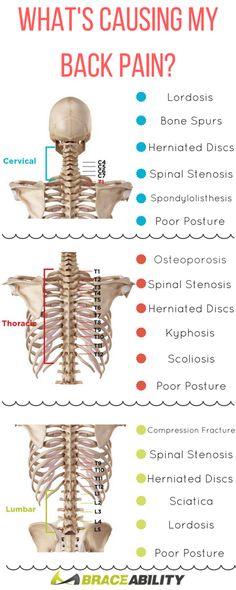 What's causing your back pain? Learn about the many lower, middle, & upper back conditions that can occur to your spine & cause you discomfort. | BraceAbility Lumbar Lordosis, Pain Chart, Bolesti Chrbta, Middle Back Pain, Back Pain Remedies, Upper Back Pain, Human Skeleton, Back Pain Exercises, Body Pain