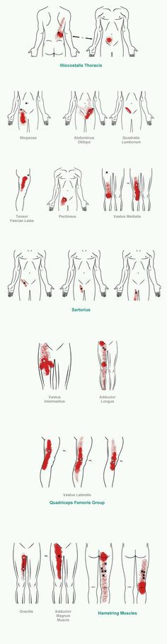 Punkty Spustowe, Myofascial Pain Syndrome, Body Muscles, Trigger Point Therapy, Trigger Point, Sports Massage, Trigger Points, Massage Techniques, Reflexology