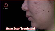 Acne scars are a common aftermath of severe acne, varying in type and appearance. It can be bothersome. If one wants to get rid of their scars, one can visit Charma Clinic to get a proper acne scar treatment in Bangalore. Dr. Rajdeep Mysore, the clinic’s expert dermatologist and founder offers several treatments for acne scars. These include chemical peels, lasers, microneedling, dermal fillers, subcision for acne scars, and topical creams. To benefit from these acne scar treatments, visit  Charma Clinic now. Chemical Peels, Severe Acne, Acne Scar, Chemical Peel, Dermal Fillers, Mysore, Bangalore, Facial, Acne