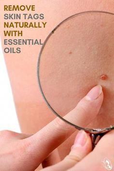 Skin tags aren’t inherently dangerous, or harmful to your health. However, having them removed is something that can be done easily enough with essential oils. Skin Tags Essential Oils, Remove Skin Tags, Remove Skin Tags Naturally, Losing 40 Pounds, Skin Natural Remedies, Skin Tags, Essential Oils Health, Cold Sores Remedies, Essential Oils For Skin