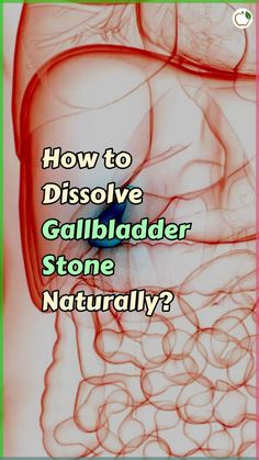 Know how to Dissolve Gallbladder Stone Naturally ❓ #healthapta #gallstones #gallbladder #naturalremedies #cholesterol #stone #bile #stayhydrated... How To Dissolve Gallbladder Stones, Diet For Gallbladder Stones, Gall Bladder Diet, Gallbladder Stones Diet, Gallstone Diet, High Cholesterol Symptoms, Gallbladder Attack, Herbal Vitamins, Gallbladder Stones