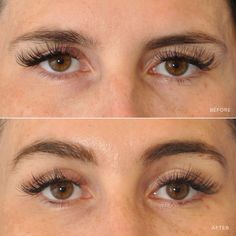 Brow Lift plastic surgery Rhinoplasty Asian, Plastic Surgery Clinic, Beauty Procedures, Neck Lift