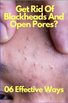 If you want to remove blackheads from skin, you have to treat open skin pores first.The best and effective solution is home remedies for blackheads and open pores problem. In this article, you will learn the best home remedies for blackheads and open pores. #blackheads #blackheadsandopenpores #openpores #blackheadsandopenporestreatment #blackheadsandopenporeshomeremedies #blackheadsandopenporescauses #blackheadsandopenporesprevention Solution For Blackheads, Pore Extraction Diy, How To Remove Open Pores, Skin Pores Remedies, Open Pores On Face How To Get Rid, Pores On Face How To Get Rid Of, Clearing Blackheads, Large Pores On Nose, Open Skin Pores