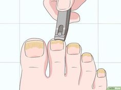 If you've noticed your toenails are discolored or thicker than normal, there's a chance you're dealing with toenail fungus. While mild cases of nail fungus aren't a serious issue, it could spread or make your nails worse if you leave it... Toenail Health, Nail Remedies, Toenail Fungus Remedies, Nail Problems, Nail Fungus Remedy, Nail Fungus Treatment, Fungal Nail, Ingrown Toe Nail, Toenail Fungus