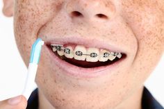 Boy with dental braces. Young boy with dental braces and toothbrushes royalty free stock photo Brackets Ideas, Adult Braces, Child Photo, Dental Braces, Teeth Braces, Brushing Teeth, Halloween Face Makeup, Royalty Free Stock Photos