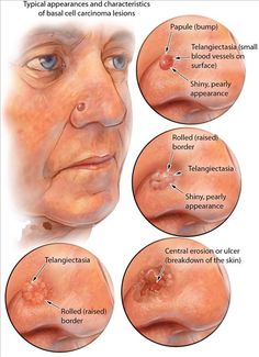 Dermatology Nurse, Wound Care, Skin Disorders, Nursing Study, Nursing Notes, Medical Knowledge, Medical Illustration