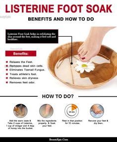 Home Foot Soak, Pedicure Soak, Listerine Foot Soak, Foot Soak Recipe, Diy Pedicure, Pedicure At Home, Athletes Foot, Foot Soak, Foot Spa