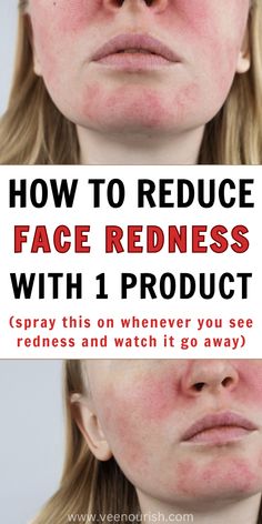 How To Get Rid Of Redness On Face With 1 Product | Skin Care Tips Face Rash Remedies How To Get Rid, How To Remove Redness From Face, How To Fix Redness On Face, Get Rid Of Redness On Face, Anti Redness Skin Care, How To Get Rid Of Red Spots On Face, How To Make Your Face Less Red, How To Get Rid Of Redness From Pimples, How To Reduce Redness On Face