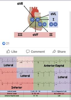 12 Lead Ekg Interpretation Cheat Sheets, Cardiac Cath Lab Nurse, Medical Assistant Student, Paramedic School, Nursing Information, Nursing School Essential, Medical School Life, Nursing School Motivation