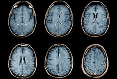 six mri images show the different areas of the brain, including one in blue and four in white