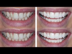 Composite Bonding Teeth, Lauren Curtis, Teeth Bonding, Composite Bonding, Teeth Remedies, Kandee Johnson, Composite Veneers, Crooked Teeth