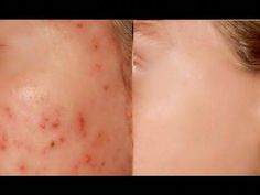 Quick remedy for How to Remove Pimples Overnight. This natural acne treatment is easy and helps you get clear skin at home. Learning how to use patanjali kan... Clear Skin At Home, Remove Pimples Overnight, To Remove Pimples, Remove Pimples, Get Clear Skin, Doodle Ideas, How To Remove Pimples