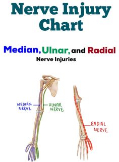 Nerve Injury/Dysfunction Chart for Median, Ulnar, and Radial Nerves **Included in the Anatomy & Kinesiology Study Guide BUNDLE** Includes: Level of Injury, Description of the Dysfunction, Visual, Muscles Acting, and Muscles Lost for the following injuries... -High Median Nerve Injury -High Median Nerve AND Low Median Nerve Injury  -Low Median Nerve Injury -High Ulnar Nerve Injury  -High Ulnar Nerve AND Low Ulnar Nerve Injury  -Low Ulnar Nerve  -Radial Nerve Injury - Proximal Humerus Injury -Radi Physiotherapy Notes, Nerve Injury, Nerve Anatomy, Radial Nerve, Hand Anatomy, Ulnar Nerve, Median Nerve, Medical Transcription