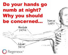 Numbness in hands while sleeping is associated with compressed nerves. Possible causes include cervical stenosis, thoracic outlet syndrome, and carpal tunnel syndrome. Tingly Numb Hands, Numbness In Fingers, Pinched Nerve In Neck, Numb Hands, Tingling Hands, Arm Numbness, Carpel Tunnel, Numbness In Hands, Hand Health