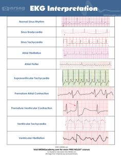 Ekg Rhythms, Ekg Tattoo, Ekg Interpretation, Nursing Cheat Sheet, Medical Assisting, Ecg Interpretation, Nursing Cheat