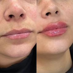 🌟 Descubra o segredo dos lábios perfeitos! 💋💄 Quanto tempo dura o preenchimento labial? Saiba mais sobre esse procedimento em nosso blog! ✨ Agende sua consulta na Duality Clinic em Porto Alegre com a Dra. Mariane Felin, a especialista em preenchimento labial. 💄💫 #PreenchimentoLabial #DraMarianeFelin #DualityClinic 🌸👄 Micropigmentation Lips, Lip Combos, Aesthetic 2024, 2024 Vision, Lip Care, Surgery