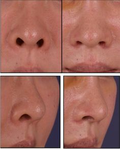 Nostril Surgery, Nostril Reduction