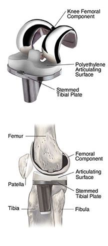 Knee Replacement Components Knee Replacement Pain, Knee Replacement Exercises, Orthopedic Nursing, Sports Therapy, Knee Replacement Surgery, Knee Surgery, Knee Replacement, Healing Modalities